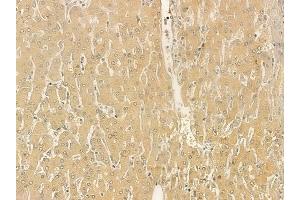 ABIN6261936 and ABIN6273247 at 1/100 staining human hepatocellular carcinoma by IHC-P.