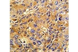 IHC analysis of FFPE human hepatocarcinoma with Cyclin A2 antibody (Cyclin A antibody  (AA 51-84))