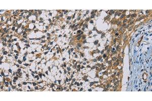 Immunohistochemistry of paraffin-embedded Human cervical cancer using CSNK1E Polyclonal Antibody at dilution of 1:60 (CK1 epsilon antibody)