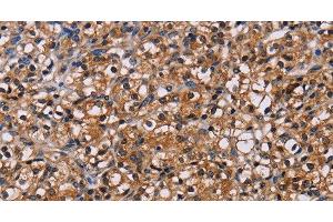 Immunohistochemistry of paraffin-embedded Human prostate cancer using NPM3 Polyclonal Antibody at dilution of 1:60 (NPM3 antibody)