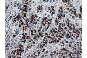 Immunohistochemical staining of paraffin-embedded Carcinoma of Human lung tissue using anti-HSPBP1 mouse monoclonal antibody.
