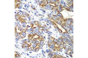 Immunohistochemistry of paraffin-embedded human gastric cancer using RALB antibody (ABIN1682468, ABIN5664619, ABIN5664621 and ABIN6220484) at dilution of 1:100 (40x lens). (RALB antibody  (AA 1-206))