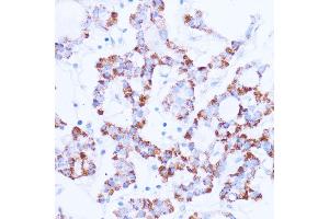 Immunohistochemistry of paraffin-embedded human thyroid cancer using SIRT3 antibody  at dilution of 1:100 (40x lens).