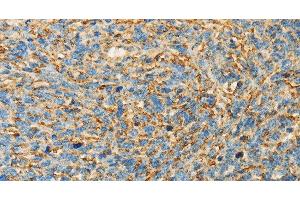 Immunohistochemistry of paraffin-embedded Human ovarian cancer tissue using APOA4 Polyclonal Antibody at dilution 1:30 (APOA4 antibody)