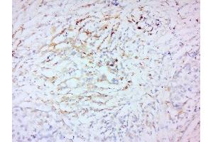 Formalin-fixed and paraffin embedded human laryngeal carcinoma labeled with Anti-MMP-2 Polyclonal Antibody, Unconjugated  at 1:200 followed by conjugation to the secondary antibody and DAB staining.