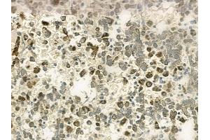 ABIN6258644 and ABIN6273728 at 1/100 staining human melanoma by IHC-P.