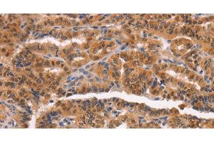 Immunohistochemistry of paraffin-embedded Human thyroid cancer tissue using NCAPG2 Polyclonal Antibody at dilution 1:50 (NCAPG2 antibody)