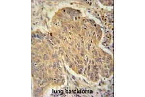 PSMD7 Antibody (C-term) (ABIN650763 and ABIN2839523) immunohistochemistry analysis in formalin fixed and paraffin embedded human lung carcinoma followed by peroxidase conjugation of the secondary antibody and DAB staining. (PSMD7 antibody  (C-Term))