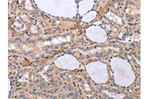 The image on the left is immunohistochemistry of paraffin-embedded Human thyroid cancer tissue using ABIN7192969(TYROBP Antibody) at dilution 1/30, on the right is treated with synthetic peptide.