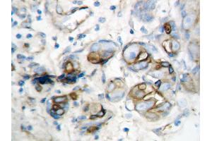 Anti-IP10 antibody, IHC(P) IHC(P): Human Mammary Cancer Tissue