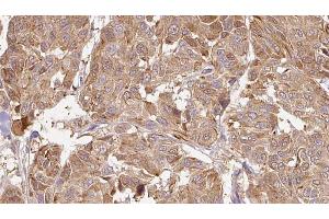ABIN6268902 at 1/100 staining Human Melanoma tissue by IHC-P. (MMP13 antibody  (N-Term))
