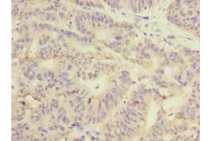 Immunohistochemistry of paraffin-embedded human colon cancer using ABIN7154098 at dilution of 1:100 (GSTK1 antibody  (AA 1-226))