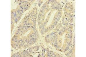 Immunohistochemistry of paraffin-embedded human colon cancer using ABIN7145012 at dilution of 1:100 (YME1L1 antibody  (AA 1-240))