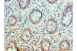 Immunohistochemistry of paraffin-embedded human colon cancer using ABIN7146355 at dilution of 1:100 (slc25a13 antibody  (AA 1-300))