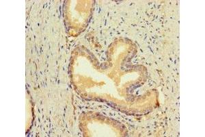 Immunohistochemistry of paraffin-embedded human prostate cancer using ABIN7145692 at dilution of 1:100 (BMP4 antibody  (AA 303-408))