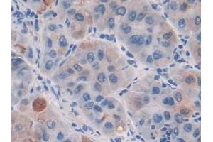 DAB staining on IHC-P; Samples: Human Liver cancer Tissue (CILP antibody  (AA 603-846))