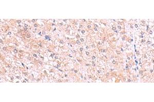 Immunohistochemistry of paraffin-embedded Human liver cancer tissue using PISD Polyclonal Antibody at dilution of 1:80(x200) (PISD antibody)