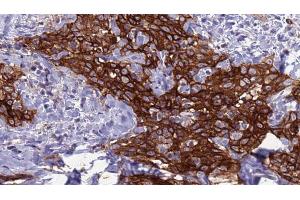ABIN6272285 at 1/100 staining Human Head and neck cancer tissue by IHC-P. (DCL1 antibody  (Internal Region))