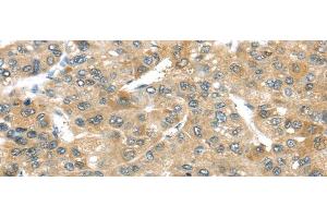 Immunohistochemistry of paraffin-embedded Human liver cancer tissue using TMPRSS4 Polyclonal Antibody at dilution 1:50 (TMPRSS4 antibody)