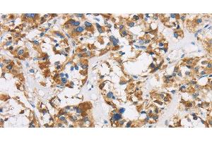 Immunohistochemistry of paraffin-embedded Human thyroid cancer using COX6B1 Polyclonal Antibody at dilution of 1:50 (COX6B1 antibody)