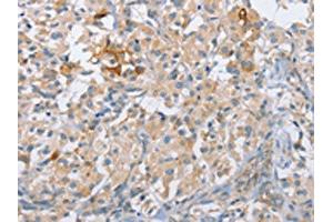 The image on the left is immunohistochemistry of paraffin-embedded Human thyroid cancer tissue using ABIN7190211(CENPE Antibody) at dilution 1/50, on the right is treated with synthetic peptide. (CENPE antibody)