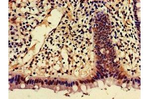 Immunohistochemistry of paraffin-embedded human colon cancer using ABIN7143368 at dilution of 1:100 (AJAP1 antibody  (AA 308-394))