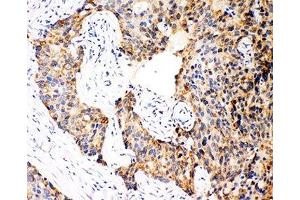IHC-P: Caspase-12 antibody testing of human breast cancer tissue (Caspase 12 antibody  (AA 71-84))