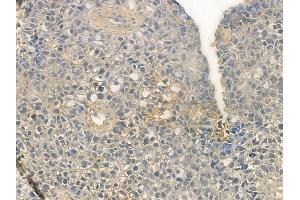 ABIN6257290 and ABIN6273658 at 1/100 staining human glioblastoma by IHC-P. (IL-25 antibody  (Internal Region))