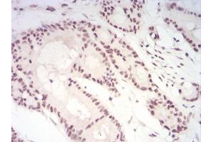 Immunohistochemical analysis of paraffin-embedded colon cancer tissues using CBX1 mouse mAb with DAB staining.