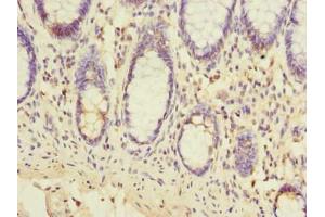 Immunohistochemistry of paraffin-embedded human colon cancer using ABIN7151978 at dilution of 1:100 (TMEM93 antibody  (AA 2-47))