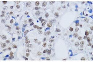 Immunohistochemistry of paraffin-embedded Human mammary cancer using DiMethyl-Histone H3-K79 Polyclonal Antibody at dilution of 1:200 (40x lens). (Histone 3 antibody  (2meLys79))