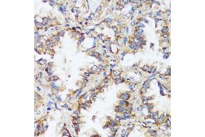 Immunohistochemistry of paraffin-embedded human lung cancer using ERK1 / ERK2 antibody (ABIN7268619) at dilution of 1:200 (40x lens). (ERK1 antibody  (AA 200-300))