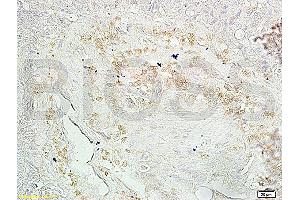 Formalin-fixed and paraffin embedded human ovary carcinoma with labeled Anti-Mtp53(N235K N239Y) Polyclonal Antibody, Unconjugated (ABIN729763) at 1:200, followed by conjugation to the secondary antibody and DAB staining (p53 antibody  (N235K, N239Y))