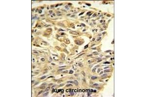 ZO1 Antibody (C-term) (ABIN650980 and ABIN2840020) IHC analysis in formalin fixed and paraffin embedded lung carcinoma followed by peroxidase conjugation of the secondary antibody and DAB staining. (TJP1 antibody  (C-Term))