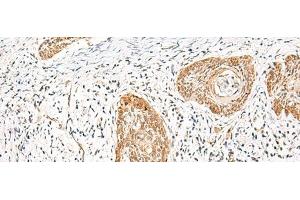 Immunohistochemistry of paraffin-embedded Human esophagus cancer tissue using HNF1A Polyclonal Antibody at dilution of 1:25(x200) (HNF1A antibody)