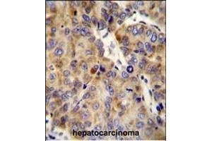 COL18A1 Antibody (Center) (ABIN654663 and ABIN2844359) immunohistochemistry analysis in formalin fixed and paraffin embedded human hepatocarcinoma followed by peroxidase conjugation of the secondary antibody and DAB staining. (COL18A1 antibody  (AA 1311-1339))
