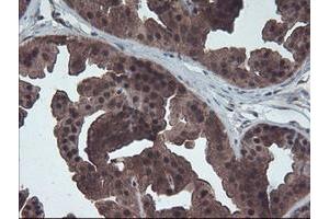 Immunohistochemical staining of paraffin-embedded Human breast tissue using anti-HDHD1 mouse monoclonal antibody.