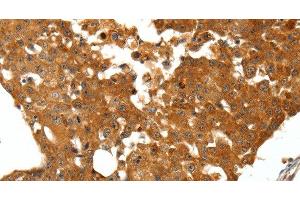 Immunohistochemistry of paraffin-embedded Human breast cancer tissue using SSTR1 Polyclonal Antibody at dilution 1:50 (SSTR1 antibody)