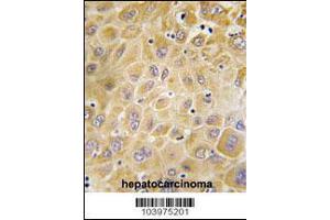 Formalin-fixed and paraffin-embedded human hepatocarcinoma tissue reacted with GRK7 Antibody , which was peroxidase-conjugated to the secondary antibody, followed by DAB staining. (GRK7 antibody  (C-Term))