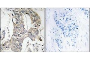 Immunohistochemistry analysis of paraffin-embedded human breast carcinoma, using MKP-1/2 (Phospho-Ser296/318) Antibody. (MKP-1/2 antibody  (pSer296))