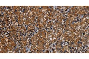 Immunohistochemistry of paraffin-embedded Human thyroid cancer tissue using IVL Polyclonal Antibody at dilution 1:50 (Involucrin antibody)