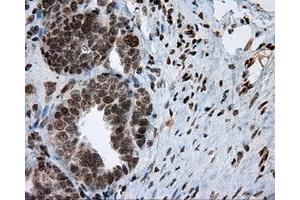 Immunohistochemical staining of paraffin-embedded Adenocarcinoma of breast tissue using anti-MCL1 mouse monoclonal antibody. (MCL-1 antibody)
