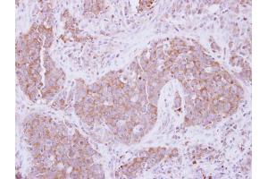 IHC-P Image Immunohistochemical analysis of paraffin-embedded human lung Papillary adenocarcinoma, using ADAM10, antibody at 1:250 dilution. (ADAM10 antibody)