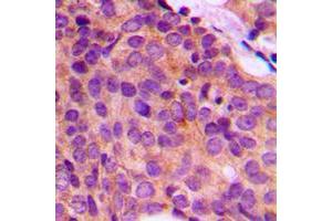 Immunohistochemical analysis of Cytokeratin 17 staining in human breast cancer formalin fixed paraffin embedded tissue section. (KRT17 antibody  (C-Term))