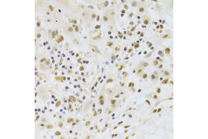 Immunohistochemistry of paraffin-embedded human liver cancer using PPP1R8 Antibody (ABIN5974046) at dilution of 1/100 (40x lens). (PPP1R8 antibody)