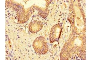 Immunohistochemistry of paraffin-embedded human prostate cancer using ABIN7174763 at dilution of 1:100 (C19ORF44 antibody  (AA 101-400))
