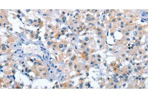 Immunohistochemistry of paraffin-embedded Human thyroid cancer tissue using ASB2 Polyclonal Antibody at dilution 1:50 (ASB2 antibody)