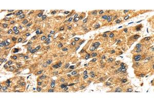 Immunohistochemistry of paraffin-embedded Human liver cancer tissue using SLC25A26 Polyclonal Antibody at dilution 1:30