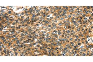Immunohistochemistry of paraffin-embedded Human esophagus cancer using PRSS50 Polyclonal Antibody at dilution of 1:30 (PRSS50 antibody)