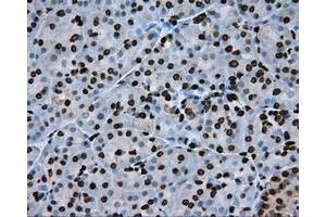 Immunohistochemical staining of paraffin-embedded Adenocarcinoma of colon tissue using anti-ARNTL mouse monoclonal antibody. (ARNTL antibody)